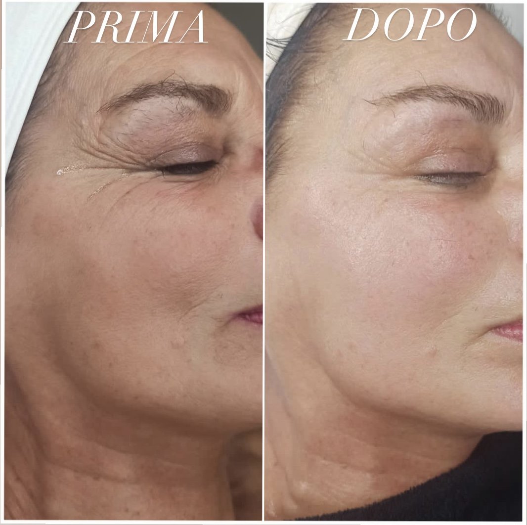 Prima e dopo, Percorso Ringiovanimento